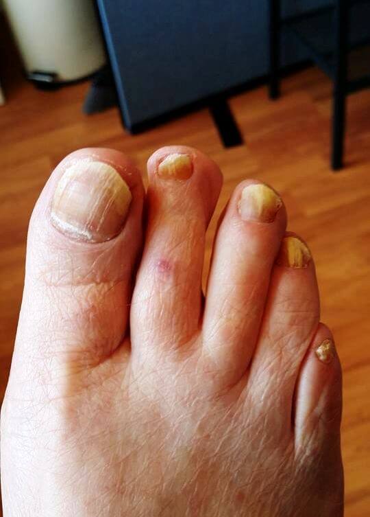 Dealing with thick, discolored toenails - Harvard Health