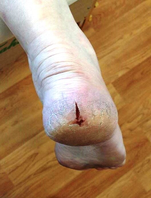 A cracked heel