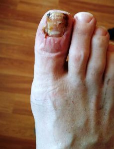 An ingrowing toe nail