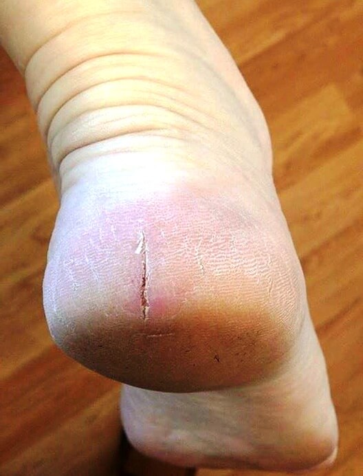 Cracked heel after treatment