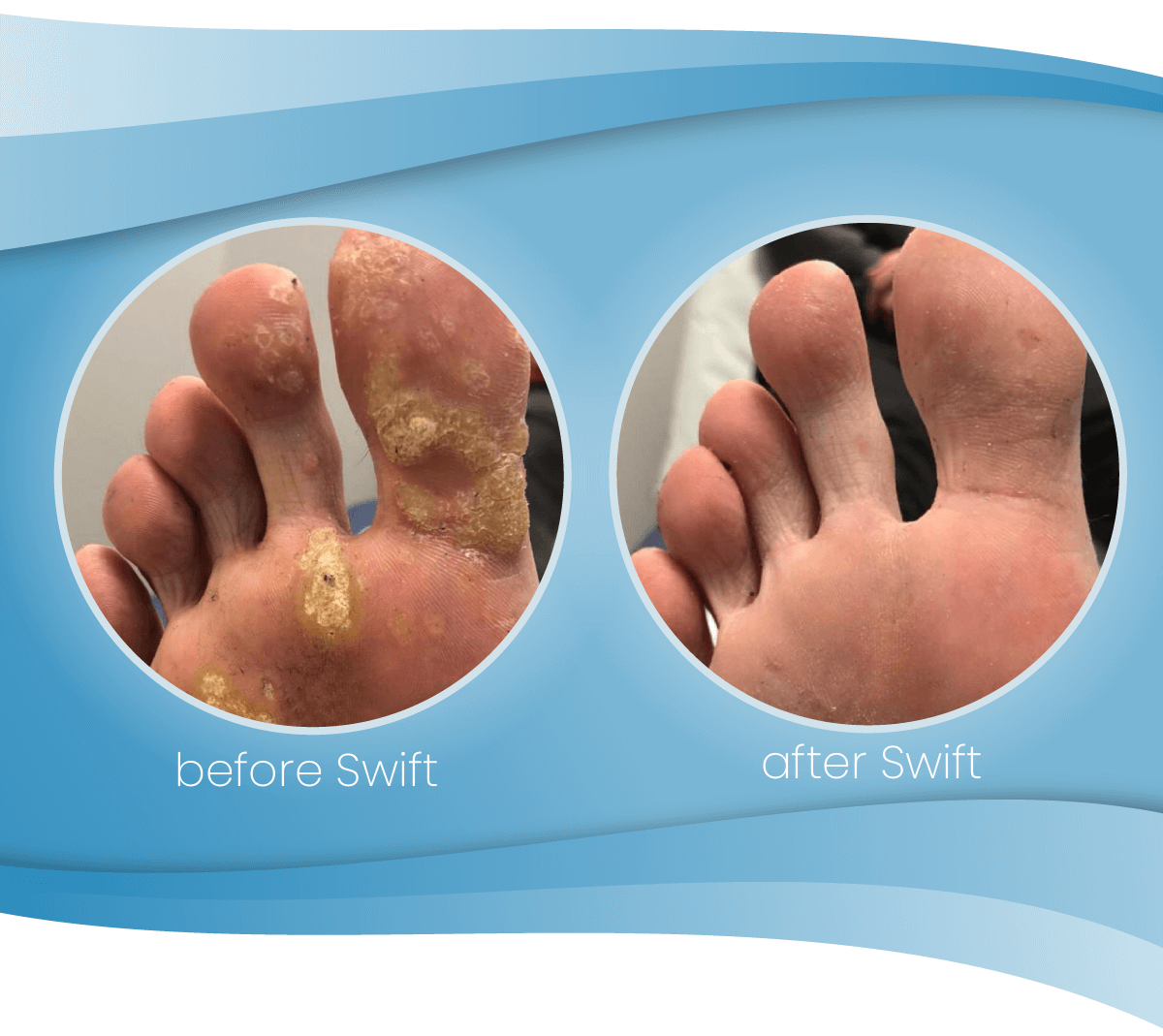 Graphic showing images of a foot before and after Swift treatment