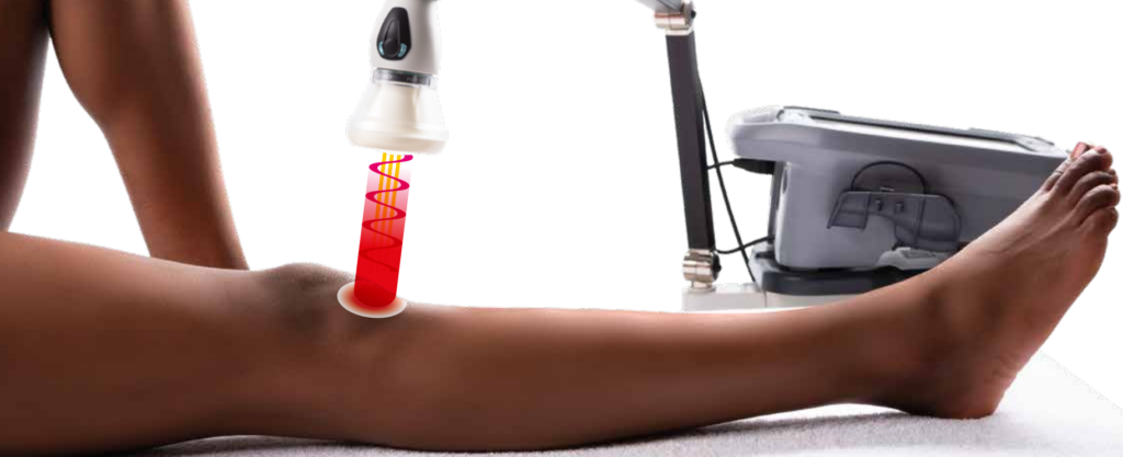 ASA laser treatment at MyPod Foot Clinic