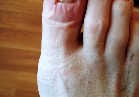 An ingrowing toe nail