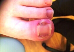 An ingrowing toe nail